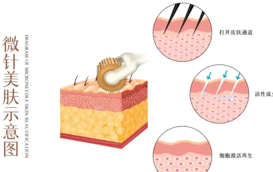 一、深圳哪里做黃金微針5代好（私立）？三家機(jī)構(gòu)全方面對比www.sorencai.cn