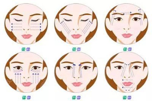 不同位置的面部提升示意圖