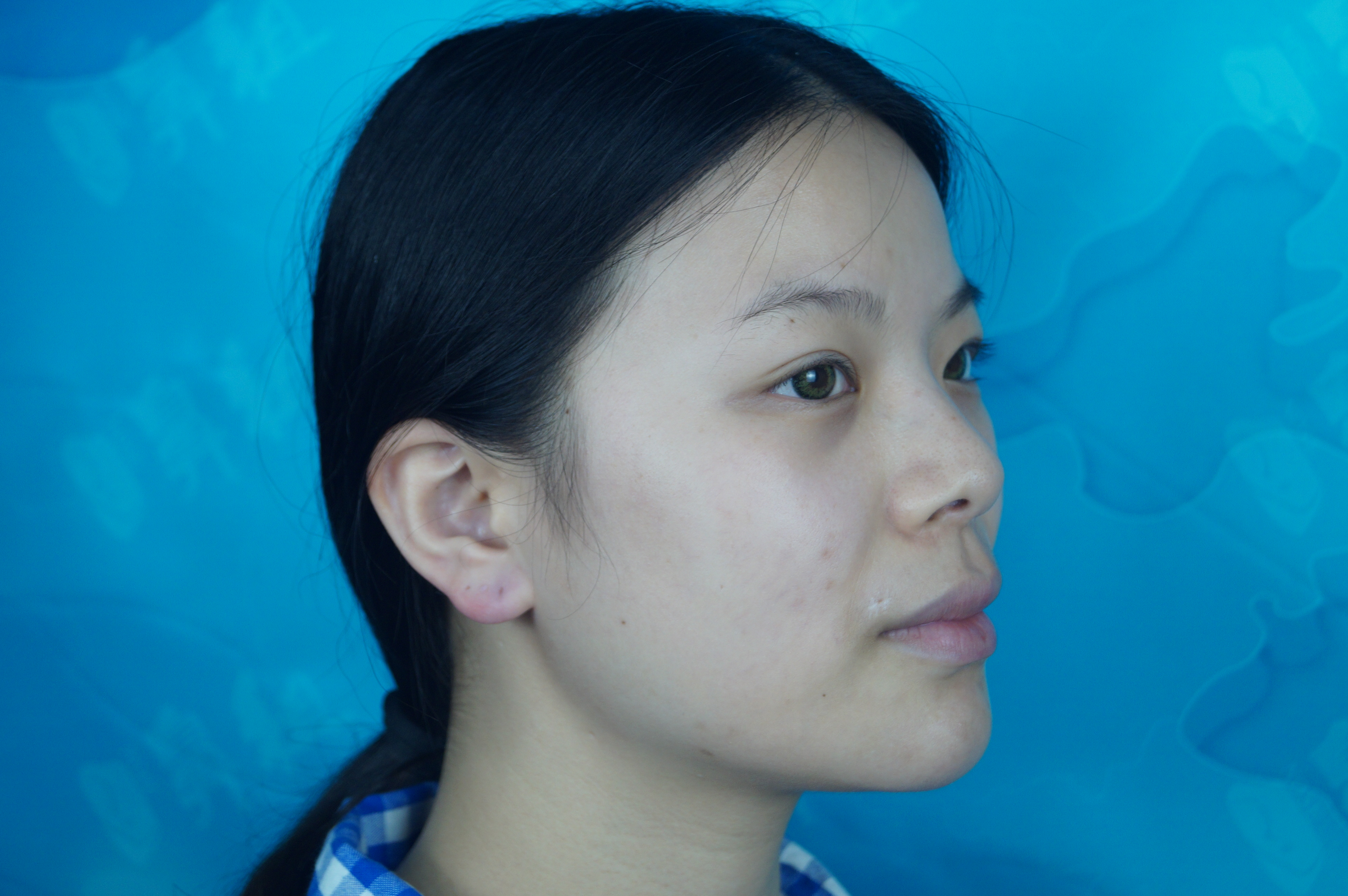 三、南京沈正宇不同技術隆胸手術的價格