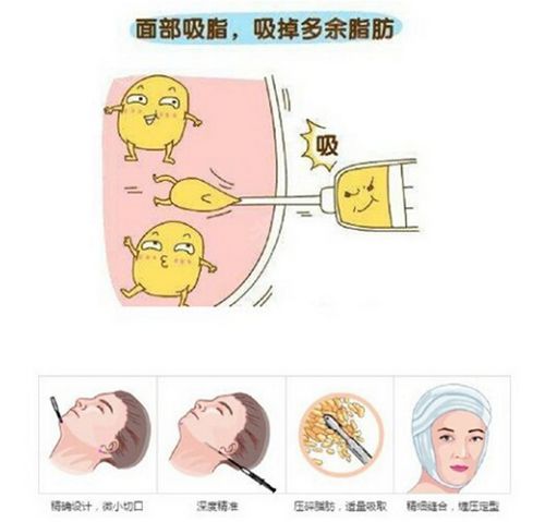 脂肪醫(yī)生梁耀嬋怎么樣