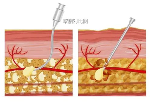 上海蔡躍波吸脂在哪家醫(yī)院