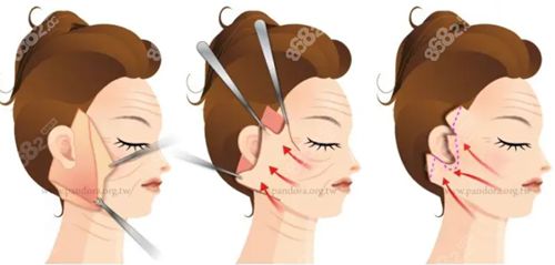 祝東升拉皮手術(shù)預(yù)約看這里