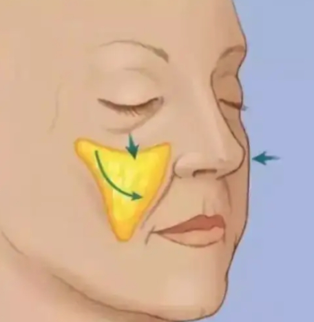 綜合評價(jià)王春虎醫(yī)生蘋果肌復(fù)位技術(shù)