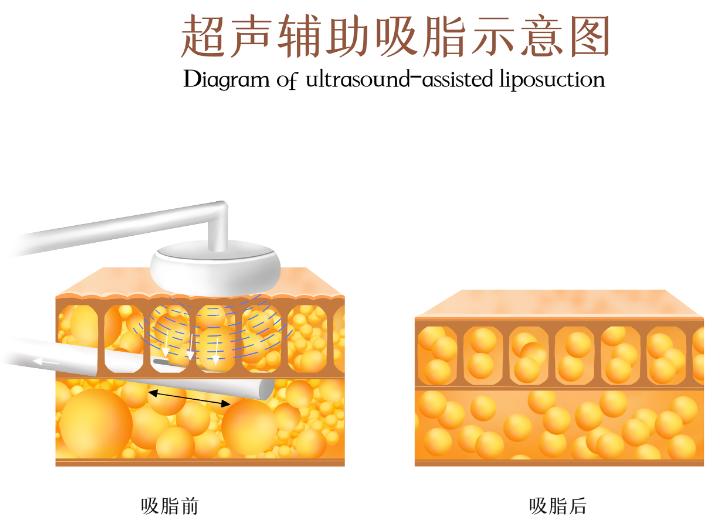 杭州吸脂馮志丹醫(yī)生的就診流程，需要注意什么？