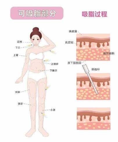 三、南寧抽脂瘦身術(shù)后變好經(jīng)驗：做好這幾點，1個月就能看到療效www.sorencai.cn