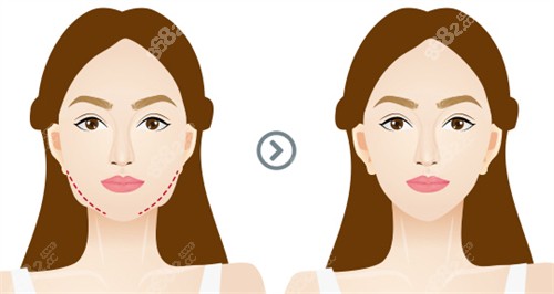 面部提升前后對比 面部提升前后對比