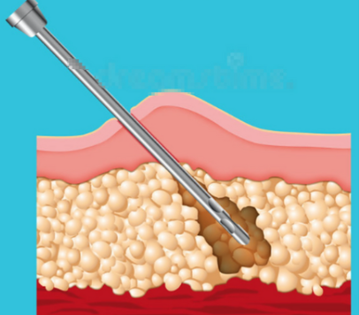 長沙鄧旭輝吸脂的技術(shù)特點