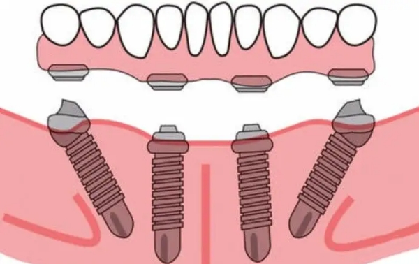 六、卡爾斯種植體品牌屬于什么檔次——從政策支持看