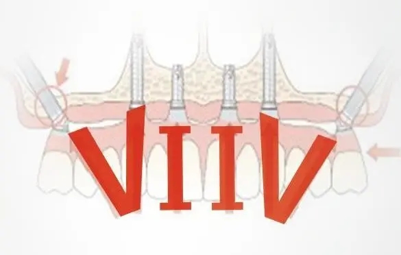 五、卡爾斯種植體品牌屬于什么檔次——從生產(chǎn)環(huán)境看