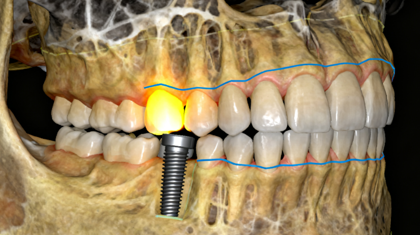 五、卡爾斯種植體多少錢一顆？注意事項