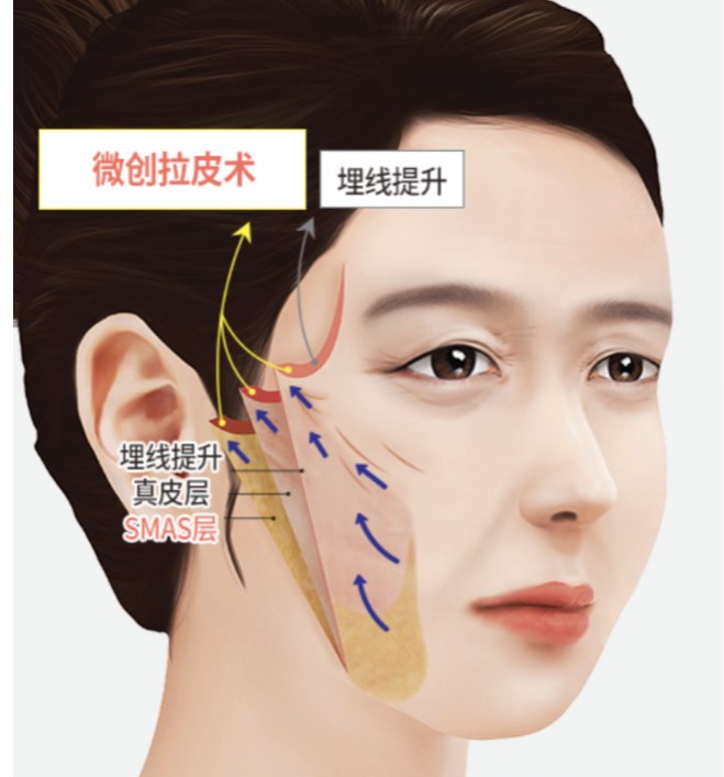 李啟壽與其他醫(yī)生的技術(shù)差異：從支架設(shè)計(jì)到操作細(xì)節(jié)看不同