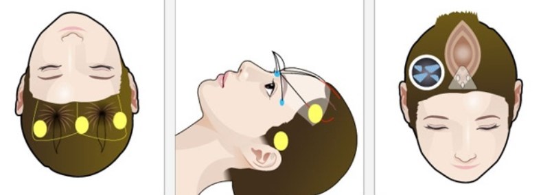 李啟壽長效面部支架提升的核心優(yōu)勢：專有技術(shù)帶來的穩(wěn)定性