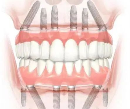 二、免費種牙騙局揭秘：有哪些被曝光的涉事機構(gòu)？www.sorencai.cn