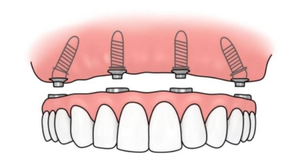 三、免費種牙騙局揭秘：如何識別騙局？
