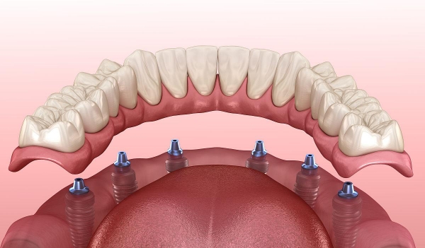 四、免費種牙騙局揭秘：正規(guī)種牙有哪些注意事項？