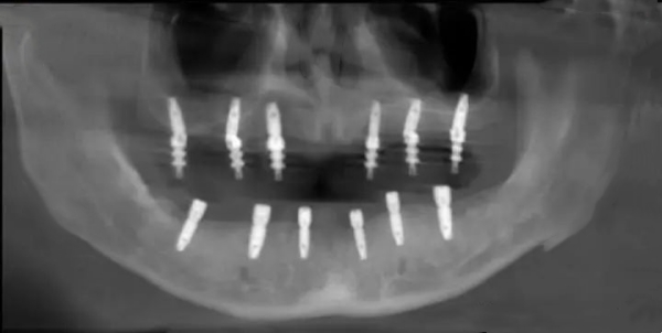 五、免費種牙騙局揭秘：有哪些真實公益種牙項目？