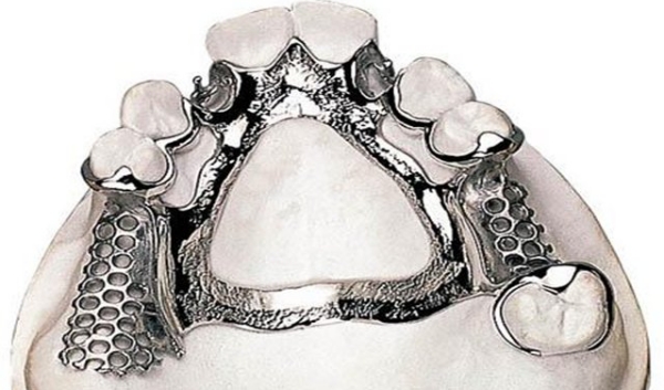 一、先搞懂：無掛鉤鑲牙是什么？粘連橋有啥優(yōu)勢(shì)？