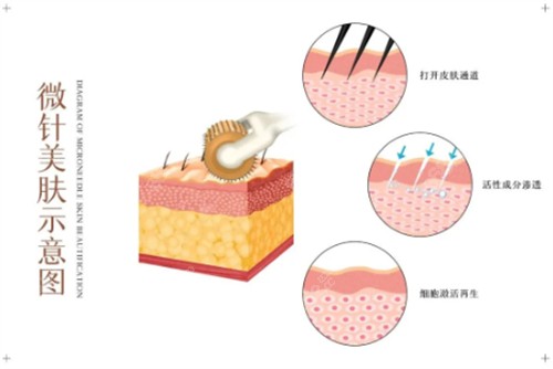 黑曜雙波黃金微針是什么