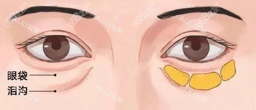 眼周眶隔脂肪位置示意圖