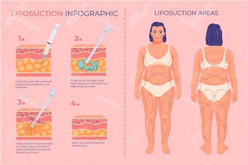 吸脂前后對比照