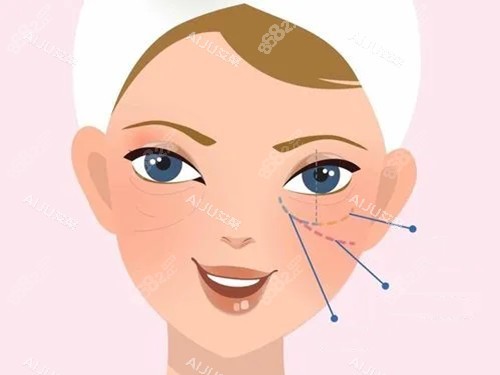 眼周不同位置示意圖