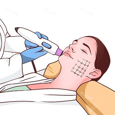 黃金微針操作圖