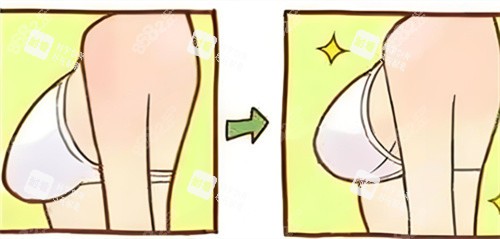 胸部縮小術(shù)前后對比動畫圖
