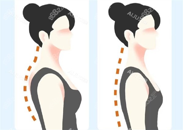 富貴包矯正手術