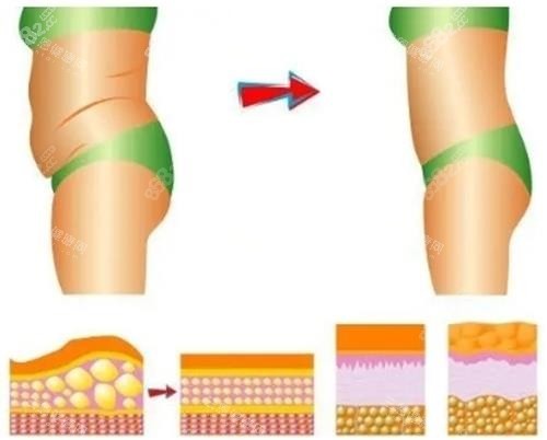 吸脂過程前后示意圖