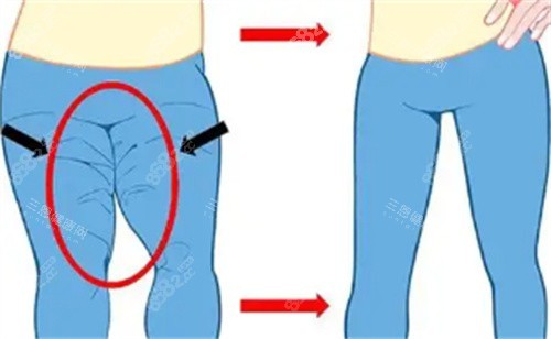 大腿吸脂對比