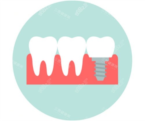 種植牙模擬卡通圖