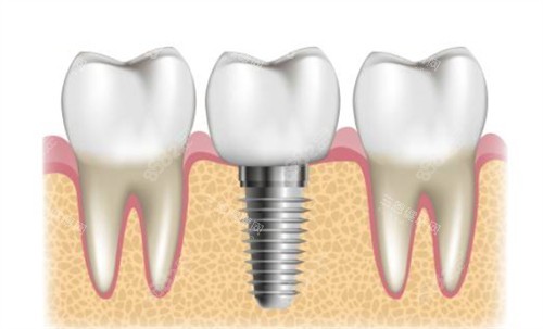 種植牙周圍健康牙