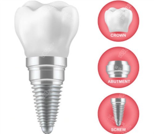 種植牙的三部分 種植牙的三部分