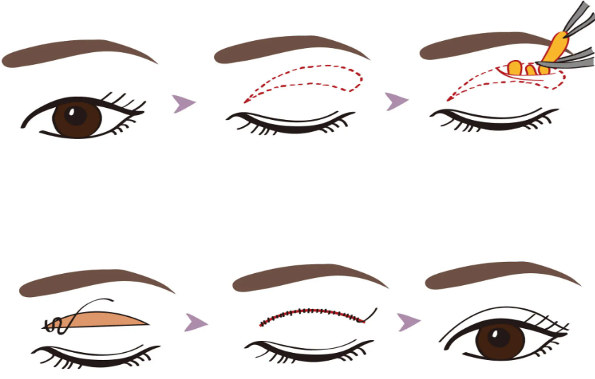 眼鼻手術(shù)價格參考（2026年全新）