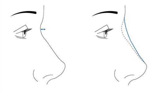 隆鼻手術(shù)前后對比 隆鼻手術(shù)前后對比