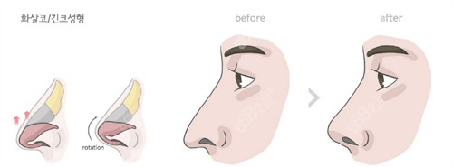 隆鼻前后對比圖 隆鼻前后對比圖