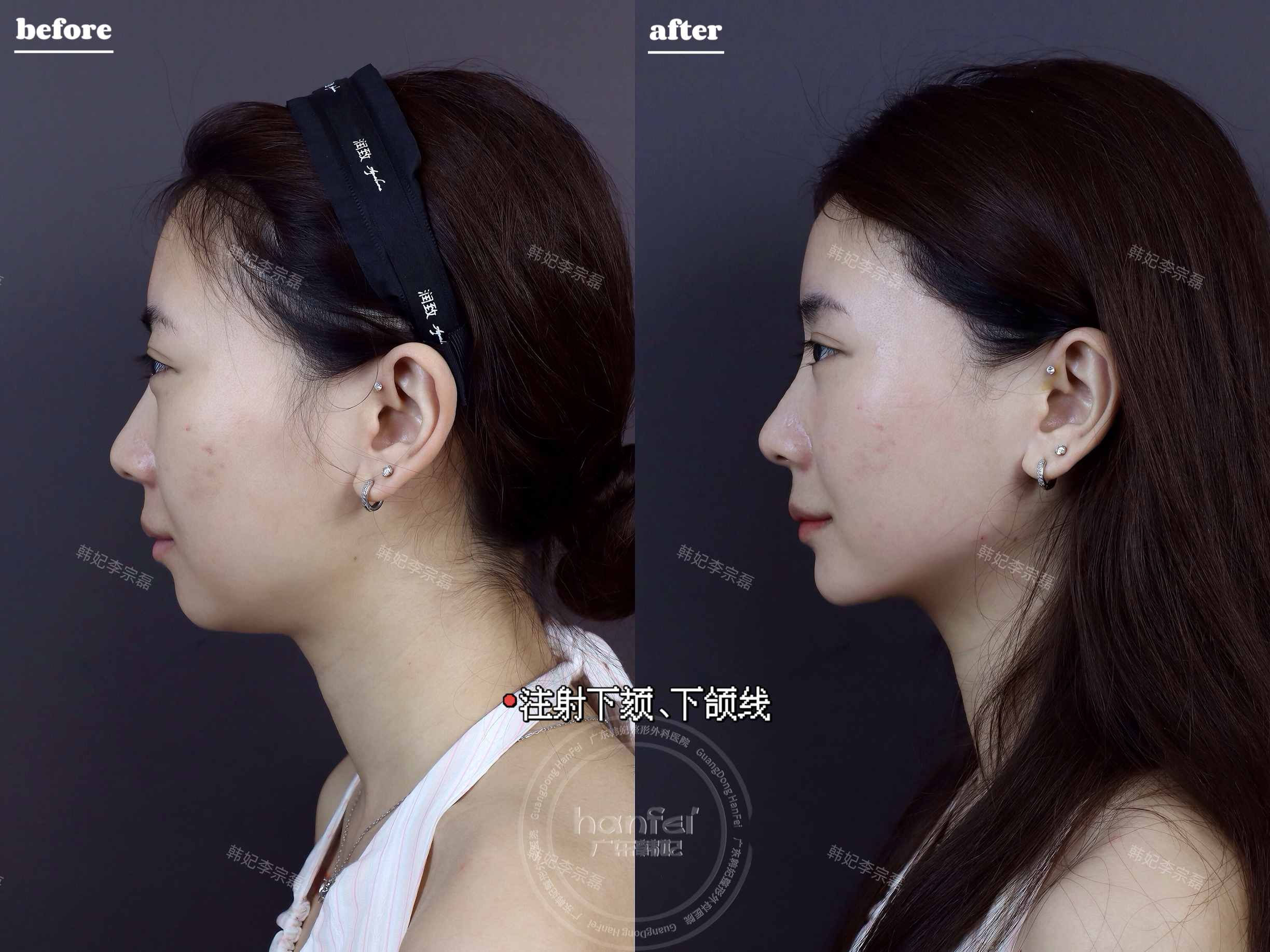 高周波儀器治療的優(yōu)勢(shì)