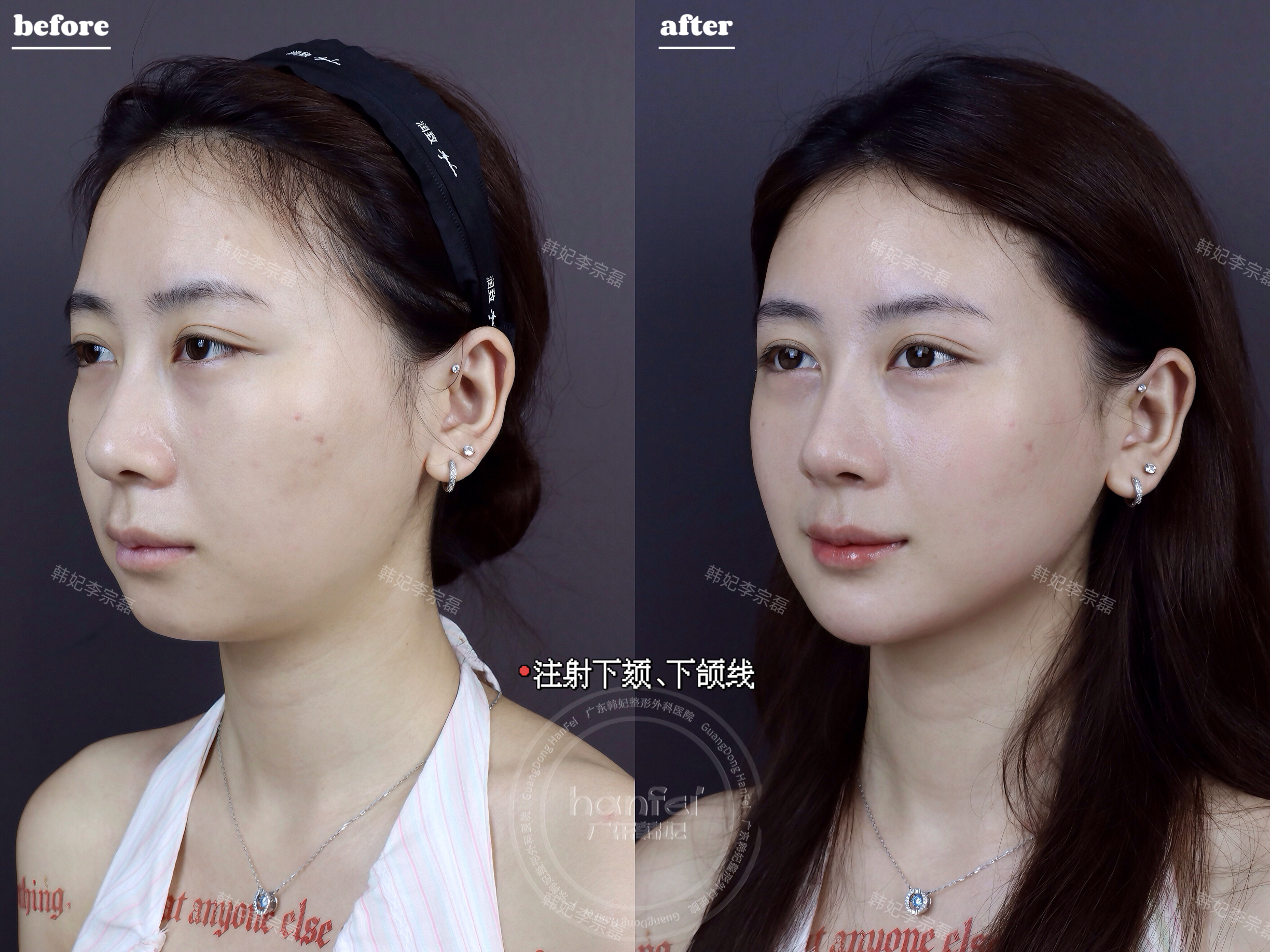 注射溶解方式的特點(diǎn)