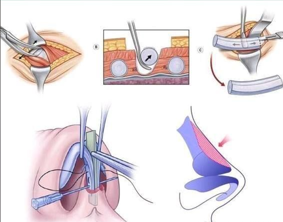 劉玉濤隆鼻修復(fù)技術(shù)特點(diǎn)與適用場(chǎng)景www.sorencai.cn