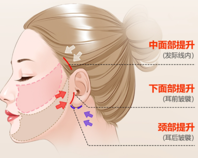 口周抗衰用啥辦法好？醫(yī)美其他方法參考