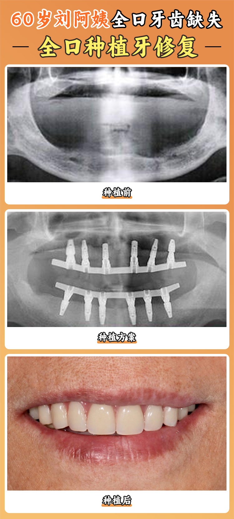 四、寧海種植牙集采政策與價(jià)格變化趨勢(shì)