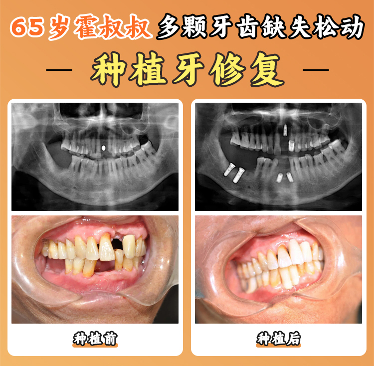 六、總結(jié)：寧海種植牙哪里便宜？看完你就懂了！