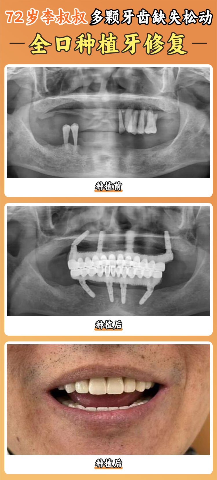 一、寧海種植牙價(jià)格區(qū)間概覽