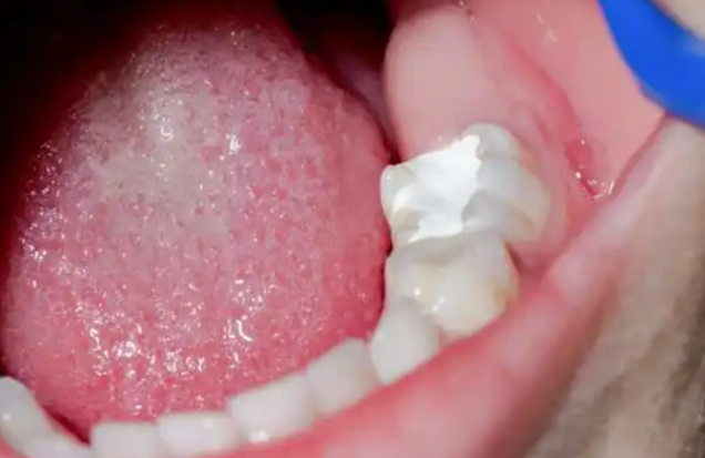 一、意大利美塑樹脂補(bǔ)牙多少錢，有何實(shí)用建議？www.sorencai.cn