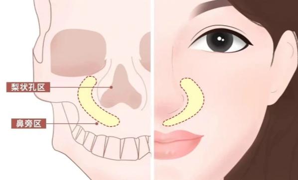 二、如何選擇適合自己的鼻基底填充醫(yī)院？www.sorencai.cn