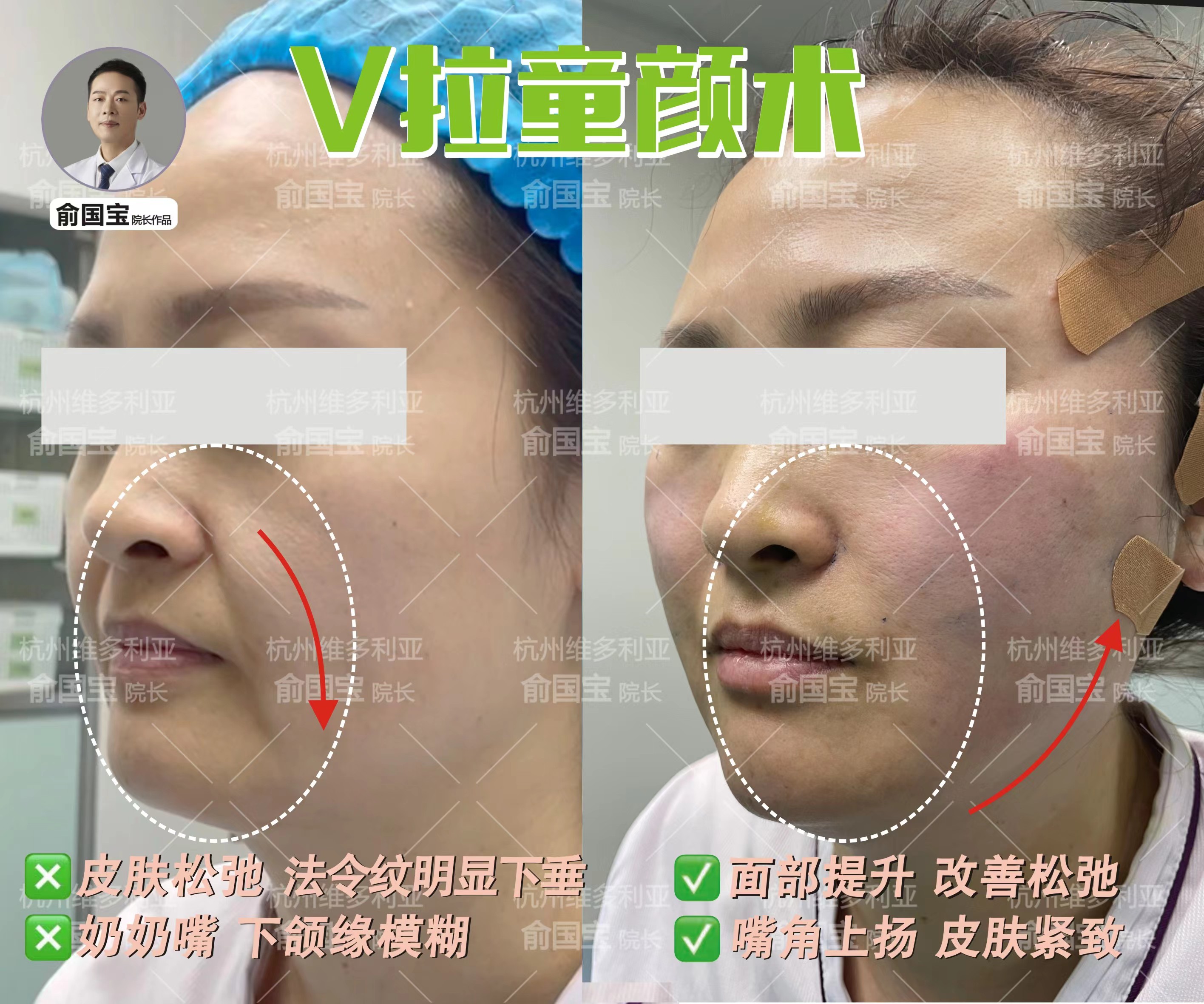 二、2026年杭州維多利亞鼻部整形價格表