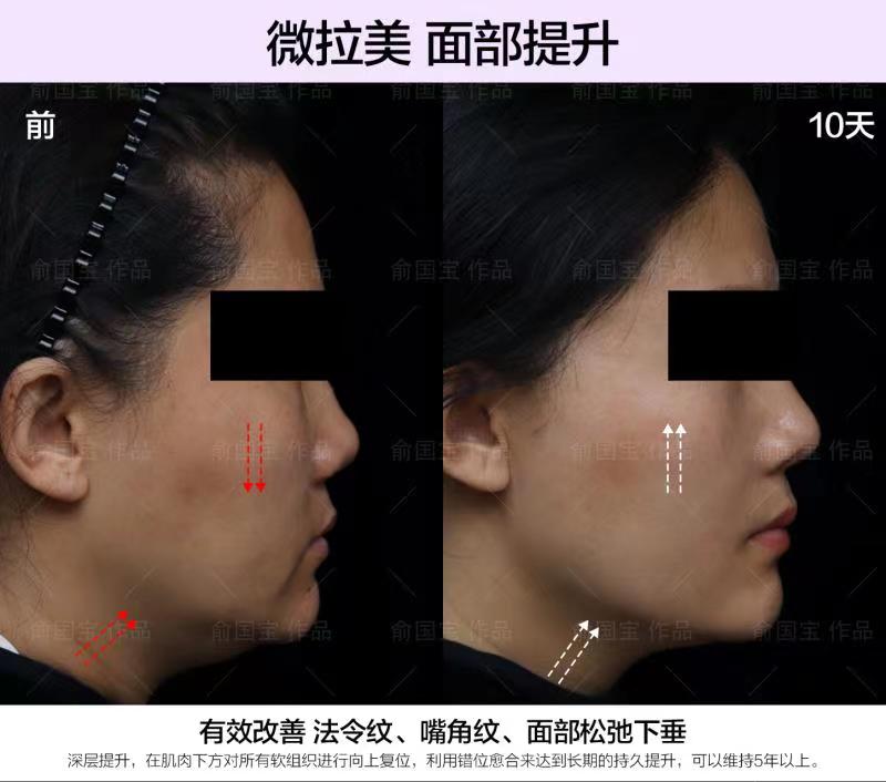 三、2026年杭州維多利亞胸部整形價格表