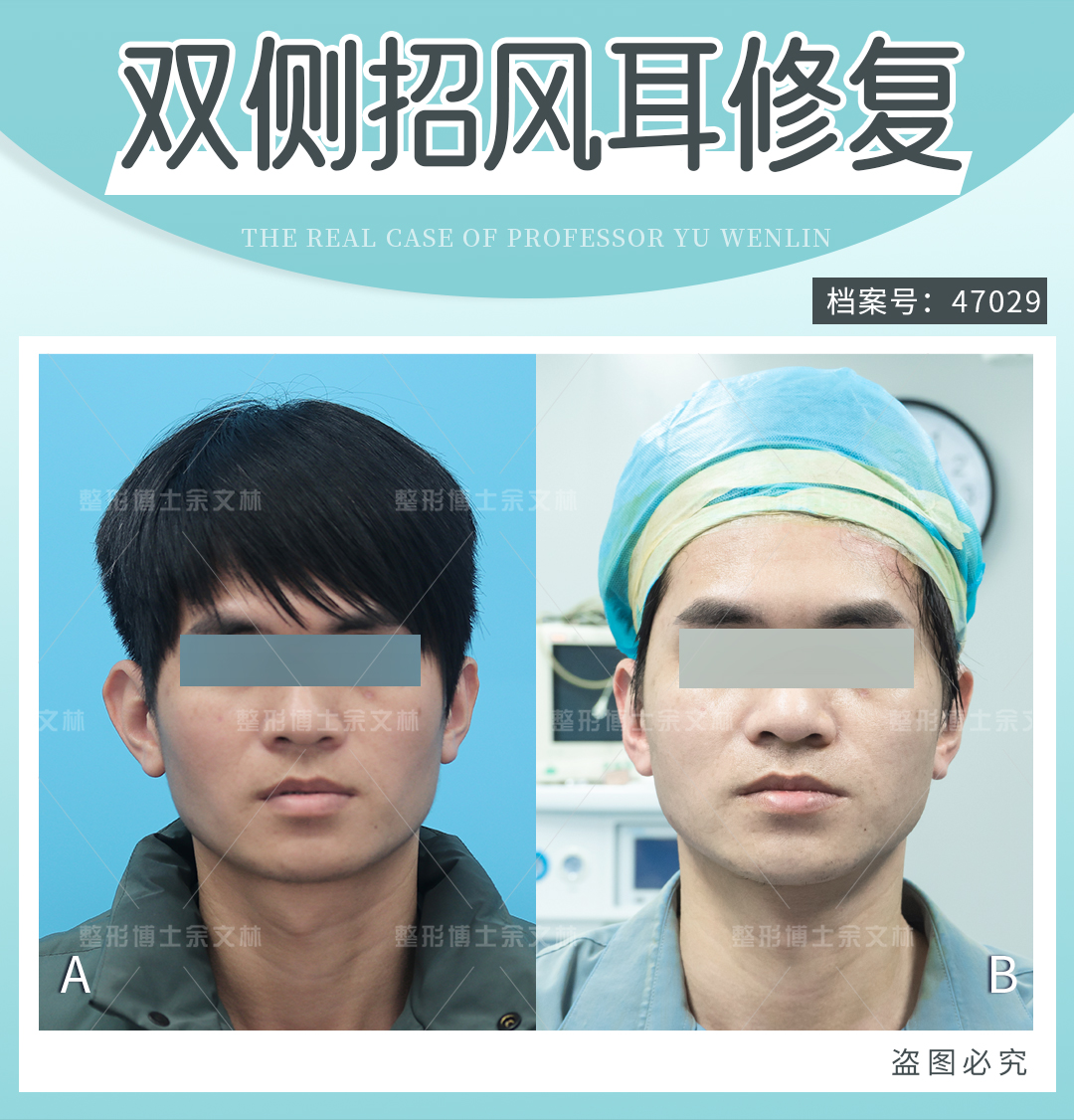 唇腭裂修復(fù)技術(shù)成熟，術(shù)后效果自然