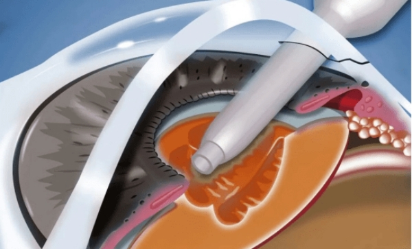 深圳一檔醫(yī)療保險(xiǎn)進(jìn)口晶體自費(fèi)費(fèi)用情況