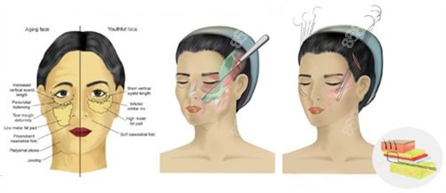 面部提升手術(shù)過程